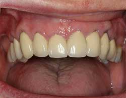 Implants replacing many missing teeth in pleasant grove, utah county