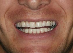 After picture of Dr. Daynes' invisalign patient in pleasant grove, ut.